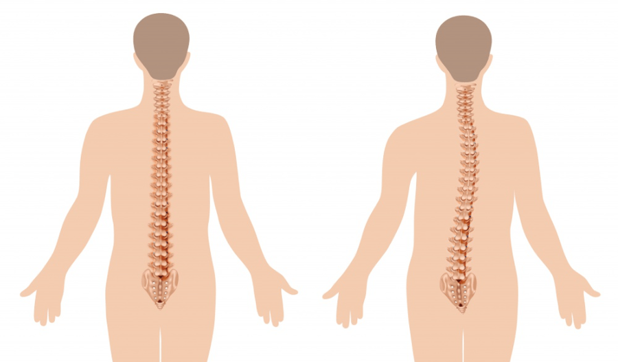 osteokondrosiaren agerpena