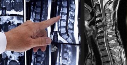 Bizkarreko mina diagnostikatzea